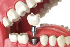 An illustration of an implant receiving its dental crown 