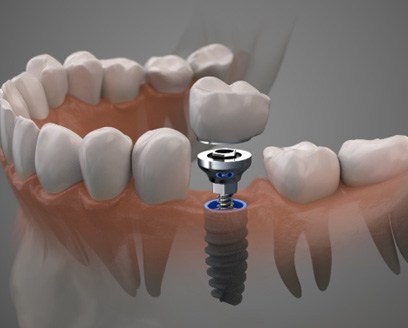 Digital illustration showing the parts of a dental implant