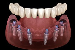 Illustration of implant dentures