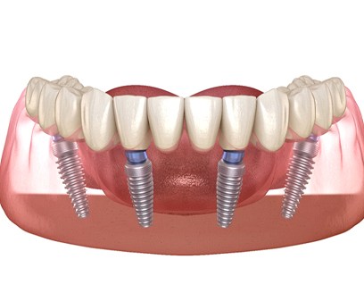 Illustration of All on 4 dental implants and denture on lower arch