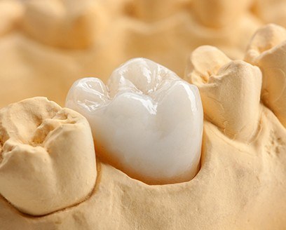 Dental crown on tooth in model of the mouth