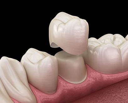 Animated dental crown being placed over lower tooth