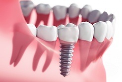 Animated implant supported dental crowns