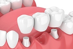 Animated dental bridge on top of two dental implants