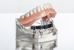 Model of implant denture