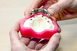 Model of All on Four implant denture system
