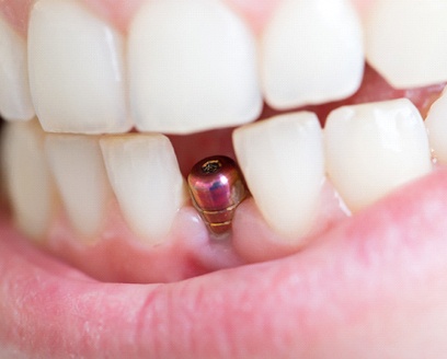 A single tooth implant in a person’s mouth