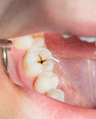 Closeup of cavity in someone’s lower tooth