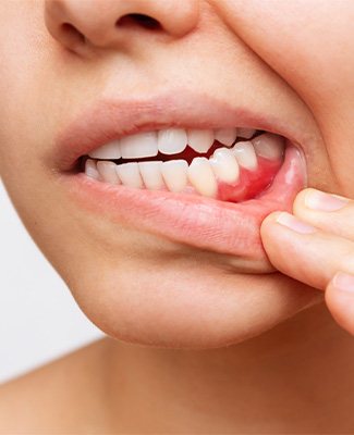 Nose-to-neck closeup of woman pulling down lip to reveal red gums