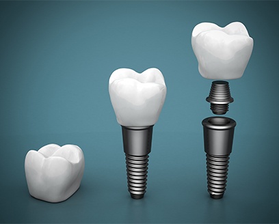 Animated dental implant abutment and dental crown