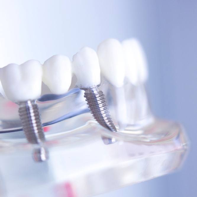 a dental implant model