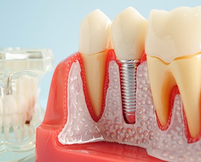 a model of a dental implant