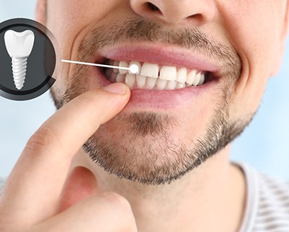 a man pointing to his dental implant