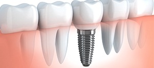 Animated dental implant with dental crown