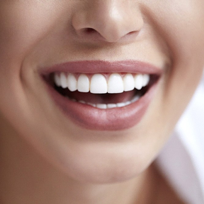 Woman with porcelain veneers in Fort Worth