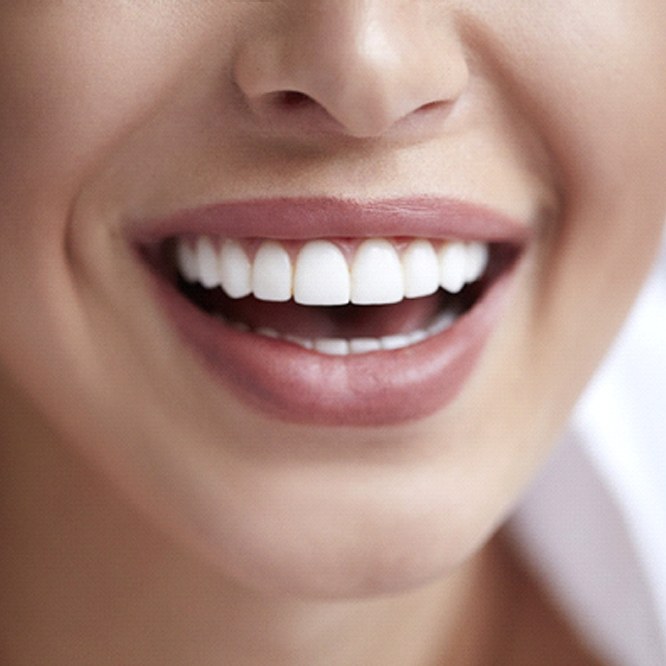 Close up of person smiling with dental veneers in Fort Worth