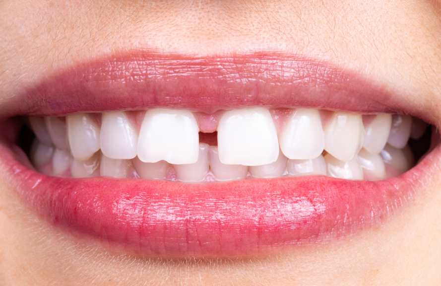 Tooth gap smile