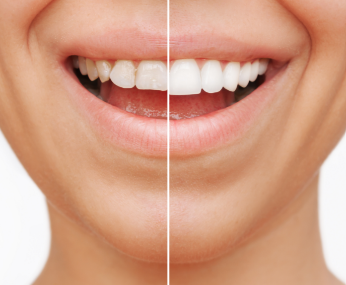 Close up of veneers