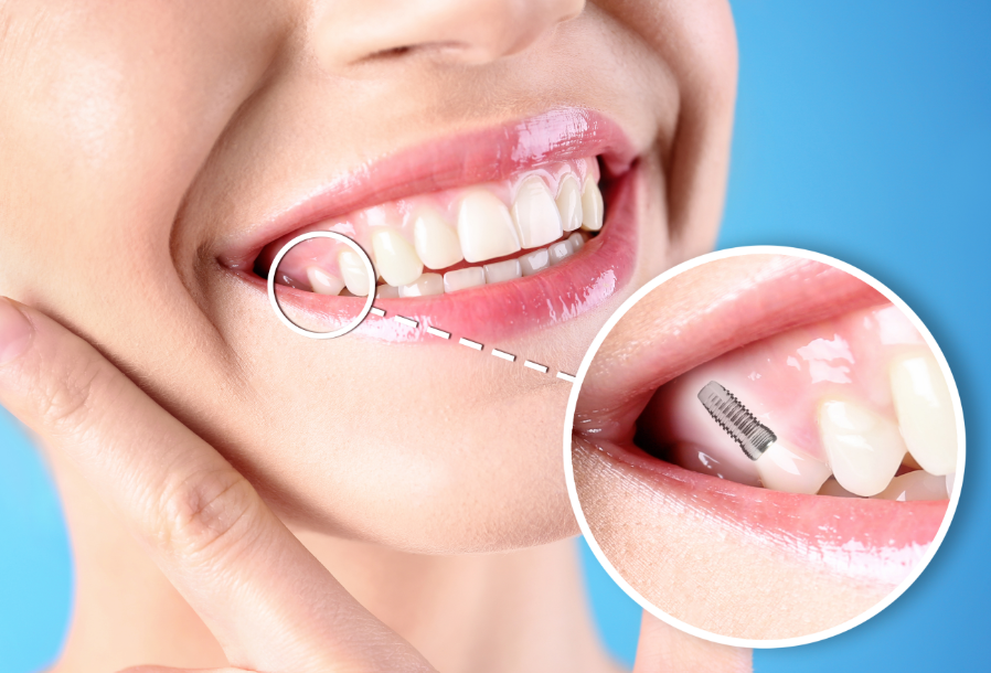 Close up of woman's smile with dental implant